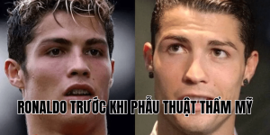Ronaldo Trước Khi Phẫu Thuật Thẩm Mỹ